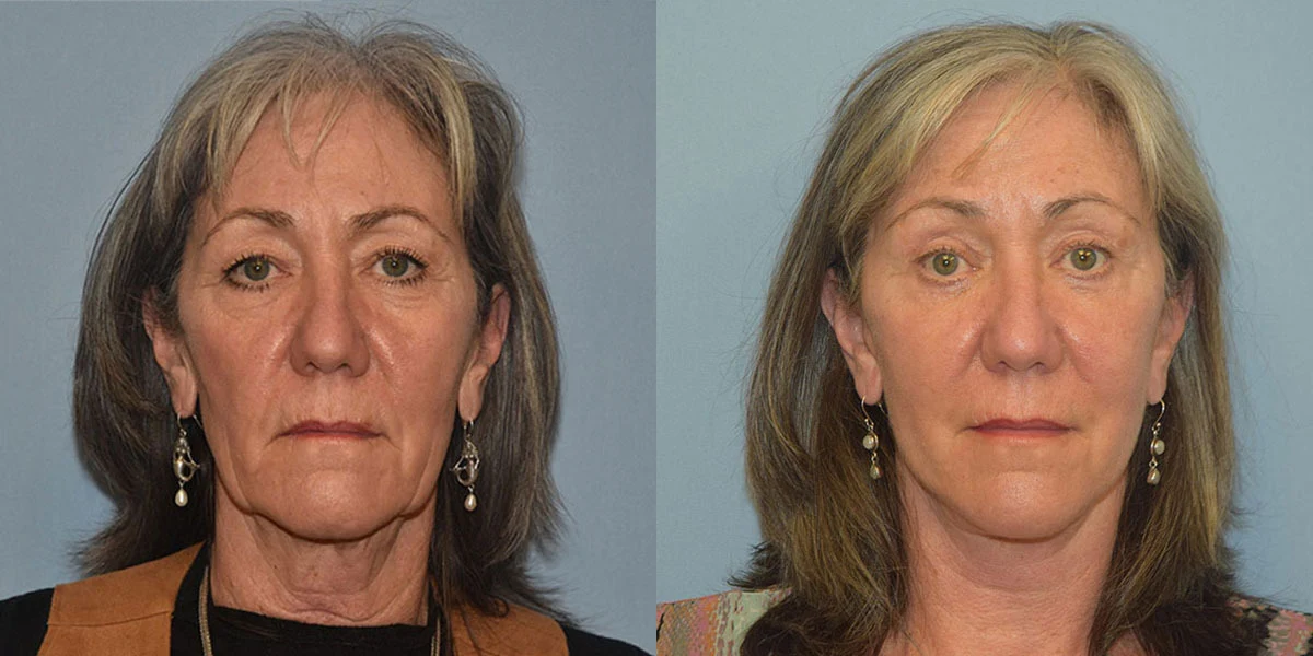 facelift before and after photos facelift before and after photos