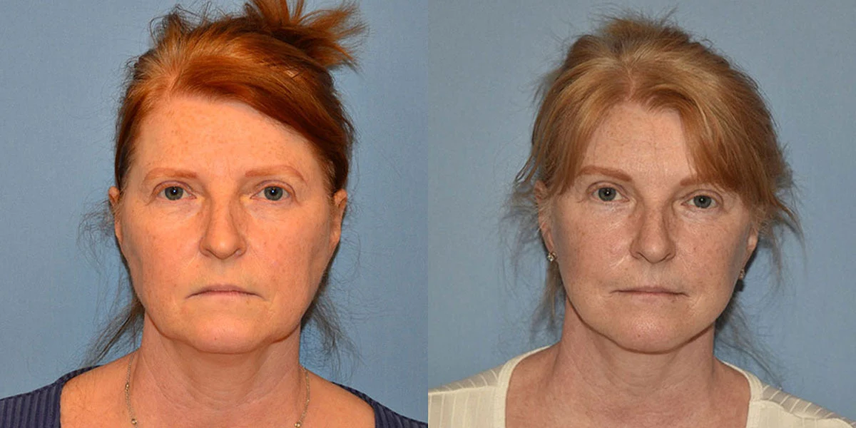 facelift before and after photos facelift before and after photos