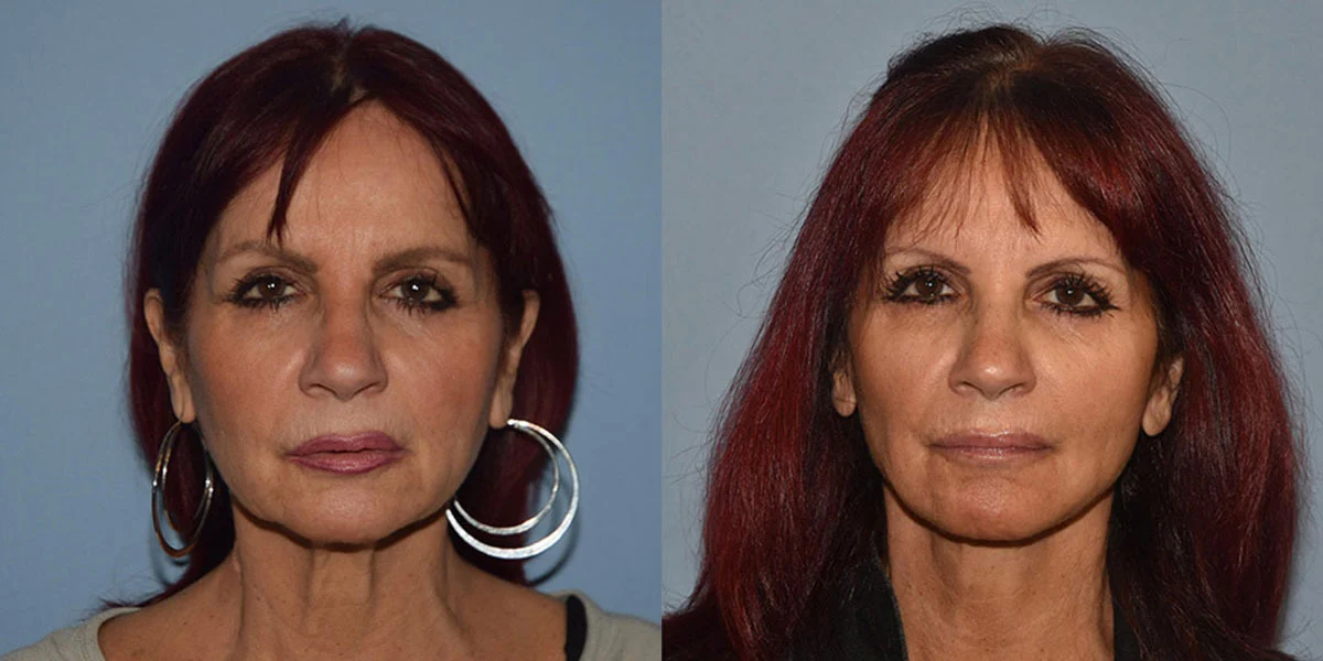 facelift before and after photos facelift before and after photos
