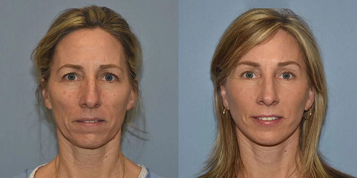 facelift before and after photos facelift before and after photos