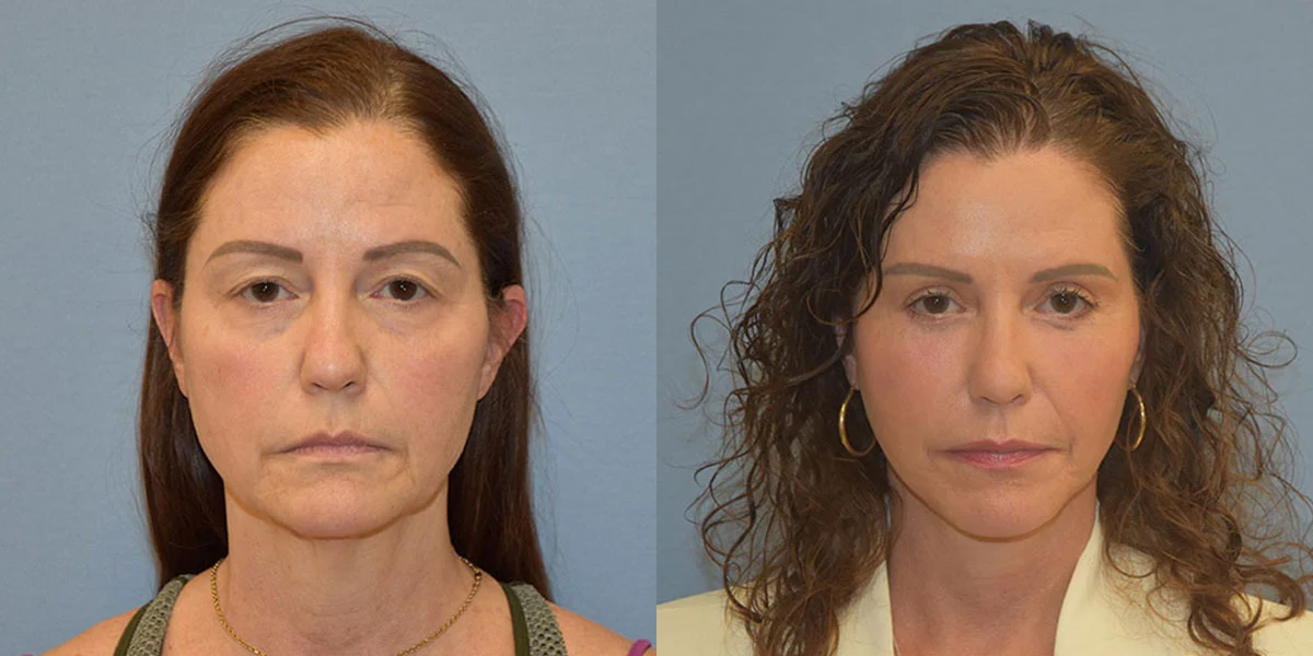 facelift before and after photos facelift before and after photos