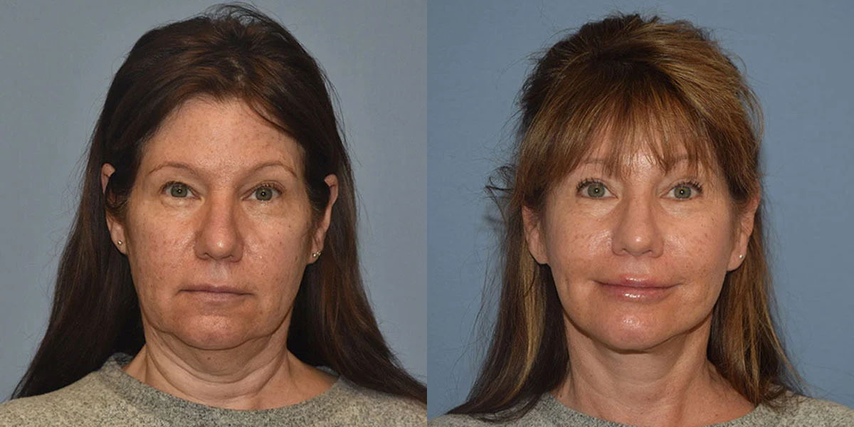 facelift before and after photos facelift before and after photos